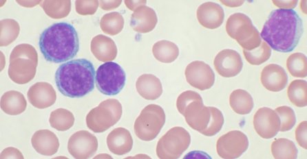 Hronična mijeloična leukemija (HML) 