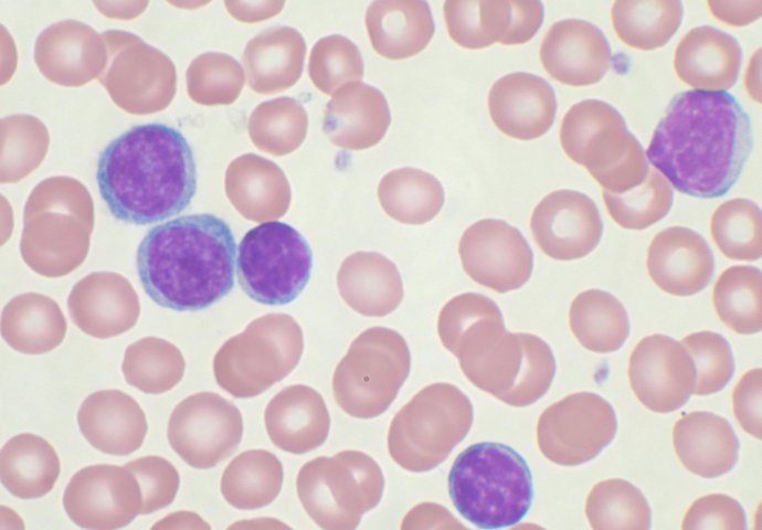 Hronična mijeloična leukemija (HML) 