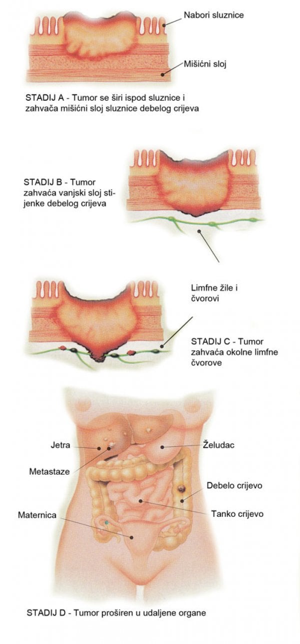 tumor-debelog-crijeva