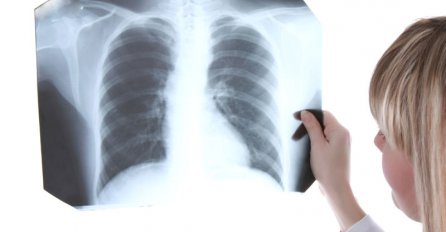 Rak pluća - uzroci, simptomi i liječenje