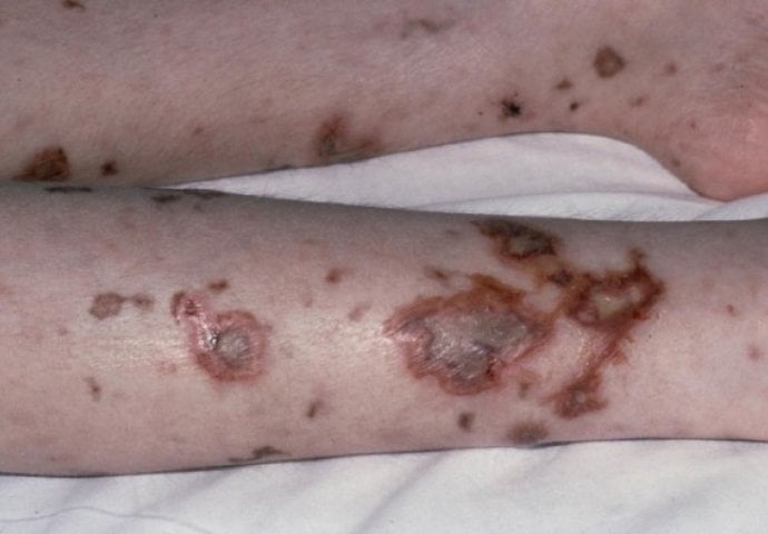 MENINGOKOKNI MENINGITIS