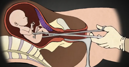 Pogledajte šta se sve dešava sa bebom tokom abortusa (STRAVIČAN VIDEO)
