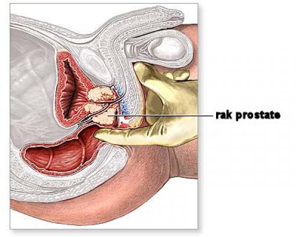 rak-prostate