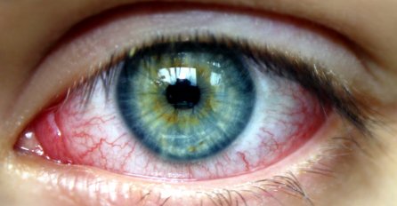 Konjuktivitis - crvenilo oka