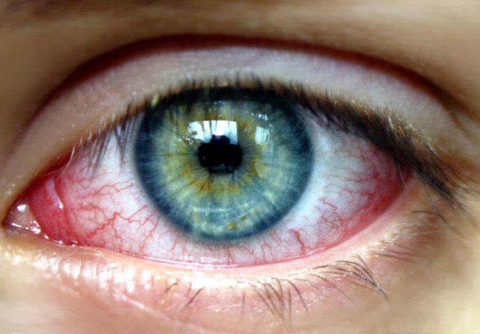 Konjuktivitis - crvenilo oka