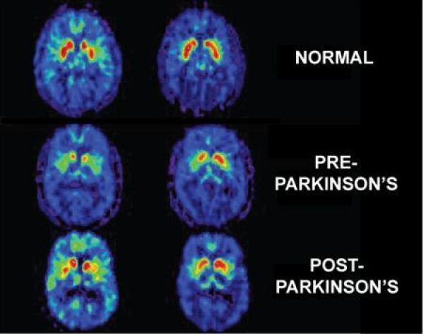 parkinson-disease