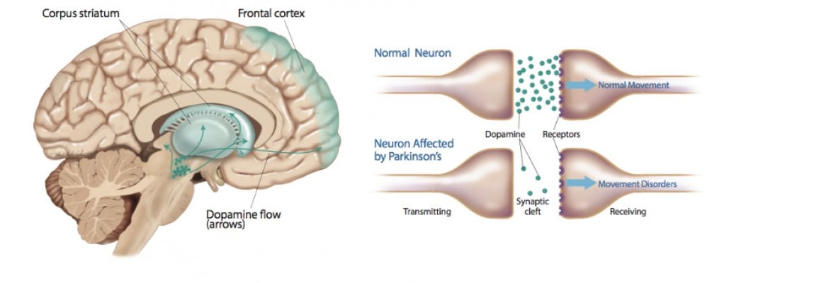 parkinson