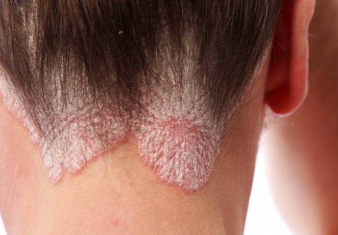 PSORIJAZA -  Uzroci, Simptomi i Liječenje