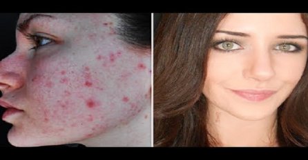To je ista žena! Pogledaj kako prekriva akne, crvenilo i ožiljke