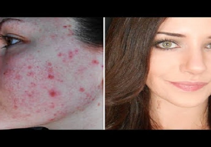 To je ista žena! Pogledaj kako prekriva akne, crvenilo i ožiljke