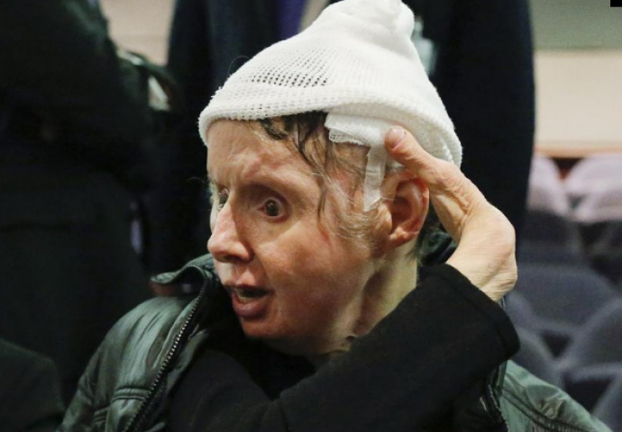 Prošla transplantaciju: Tijelo joj počelo odbacivati novo lice   