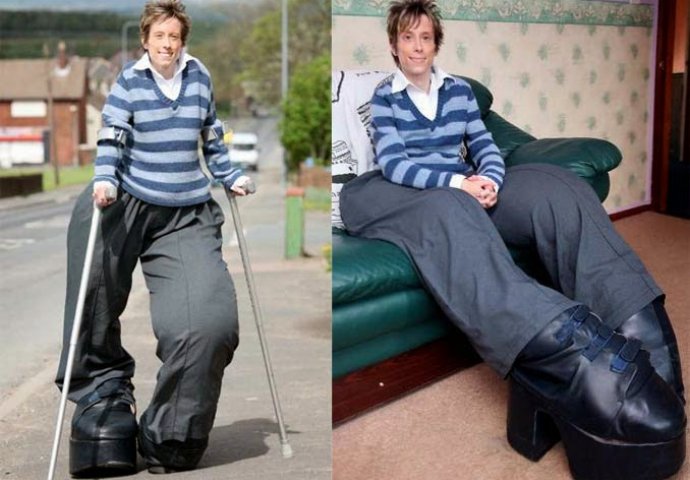 Djevojci amputirali nogu, nakon operacije noga počela ponovo rasti