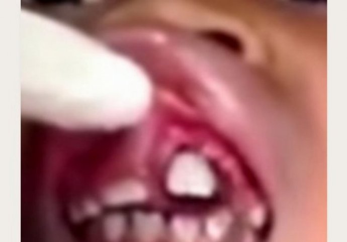 Djevojčica je osjetila da joj nešto hoda u ustima, a onda su doktori izvadili ovaj UŽAS! (VIDEO)