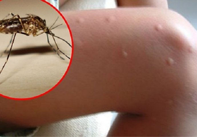 Komarci su mi uništili ljeto: "Kada sam naučila ovaj trik, nikada me više nije ugrizao" (VIDEO)