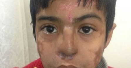 Indija: Ljekari uzgojili novi nos na čelu dječaka