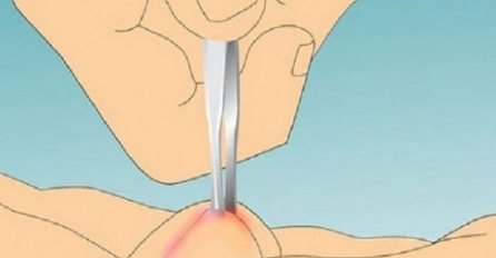 SASVIM PRIRODNO RJEŠENJE: Evo kako se riješiti uraslog nokta