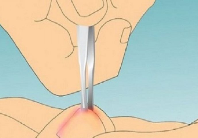 SASVIM PRIRODNO RJEŠENJE: Evo kako se riješiti uraslog nokta