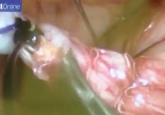 (UZNEMIRUJUĆI SADRŽAJ) Doktori su hitno operisali djevojčicu zbog bolova u stomaku, ali nisu bili spremni na ovaj užas!