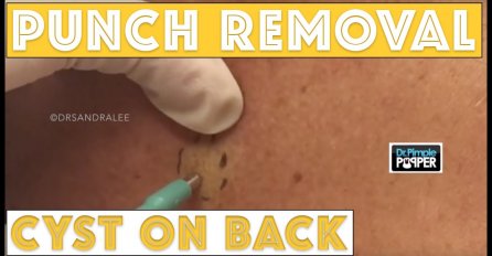 (UZNEMIRUJUĆI SADRŽAJ) Na prvi pogled je izgledalo kao ujed komarca, a onda je iz plika izašla ova grozota! 