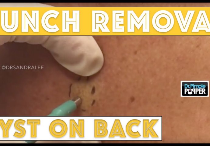 (UZNEMIRUJUĆI SADRŽAJ) Na prvi pogled je izgledalo kao ujed komarca, a onda je iz plika izašla ova grozota! 