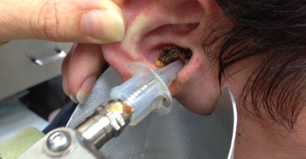 Neko je zaboravio šta znači higijena: Otišao je na ispiranje ušiju, pa mu ovu grozotu izvadili! (VIDEO)