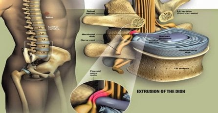 Liječenje diskurs hernije: Umjesto operacije pokušajte s prirodnim rješenjem