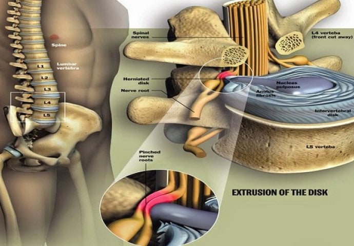 Liječenje diskurs hernije: Umjesto operacije pokušajte s prirodnim rješenjem