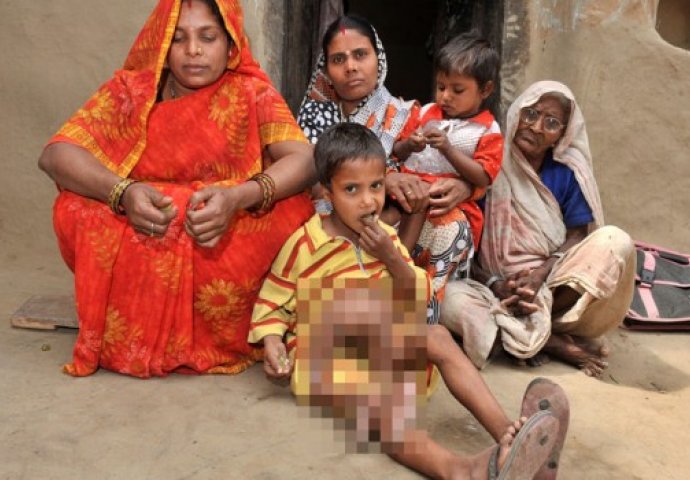 Zvali su ga dječak sa 8 udova, ali nećete vjerovati kako on danas izgleda (FOTO) 