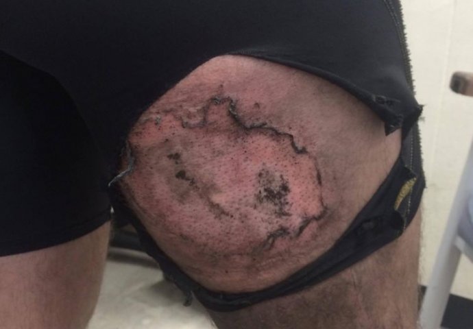 Zaradio teške opekline nakon što mu je eksplodirao  iPhone u džepu