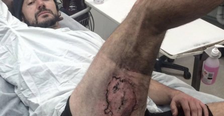 Zaradio teške opekline nakon što mu je eksplodirao  iPhone u džepu