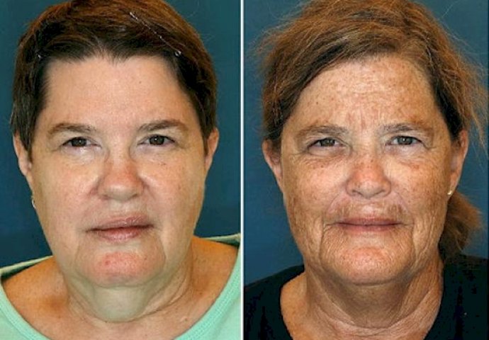 Kad vidite zastrašujuće razlike između blizanaca pušača i nepušača, ODMAH ćete ostaviti cigarete!