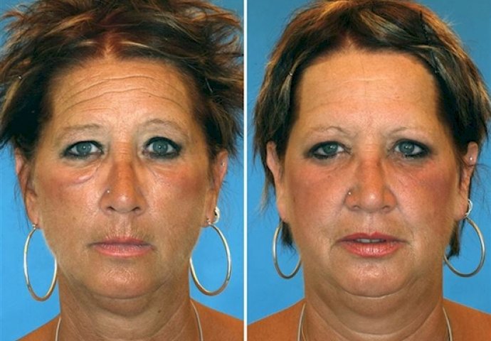 Kad vidite zastrašujuće razlike između blizanaca pušača i nepušača, ODMAH ćete ostaviti cigarete!