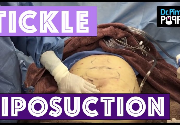 Ovo do sada niste imali priliku da vidite: Evo kako izgleda liposukcija (VIDEO)