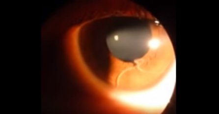 Nešto je "žuljalo" u oku, kada je otišla doktoru ustanovili su joj nešto jezivo (VIDEO)