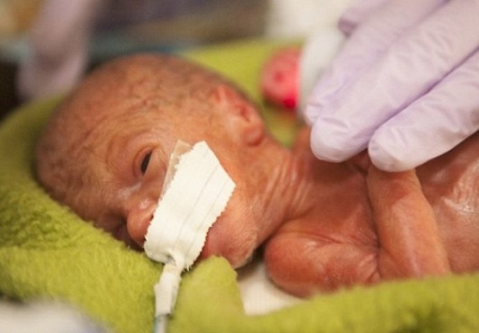 Ova prerano rođena beba imala je samo pola kilograma, a onda se desilo pravo čudo! 