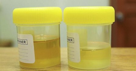 Šta znači kad je urin plav, a šta kad je boje meda? Ovo morate znati!