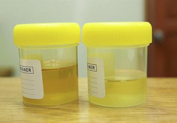 Šta znači kad je urin plav, a šta kad je boje meda? Ovo morate znati!