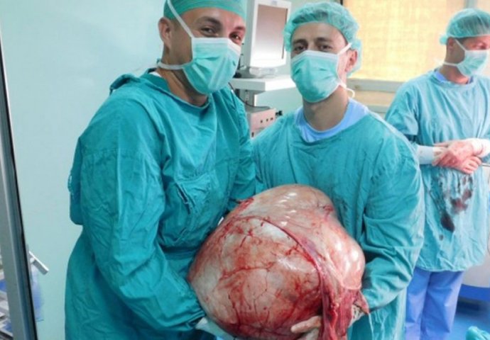 Doktori u Banjaluci izvadili tumor težak 31 kilogram