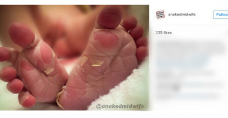 Fotografija bebinih stopala izazvala jezu na Instagramu, a onda je babica objasnila zašto se bebi ljušti koža na stopalima