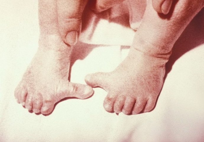 Fotografije ljudi sa 12 prstiju od kojih ćete se naježiti! 