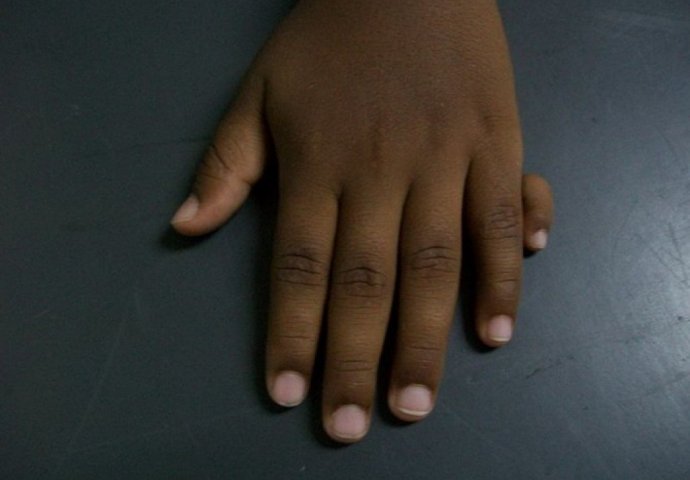 Fotografije ljudi sa 12 prstiju od kojih ćete se naježiti! 