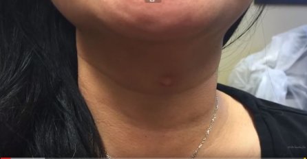 Na vratu joj se pojavila čudna izraslina, ali pogledajte šta se desilo nakon intervencije! (VIDEO) 