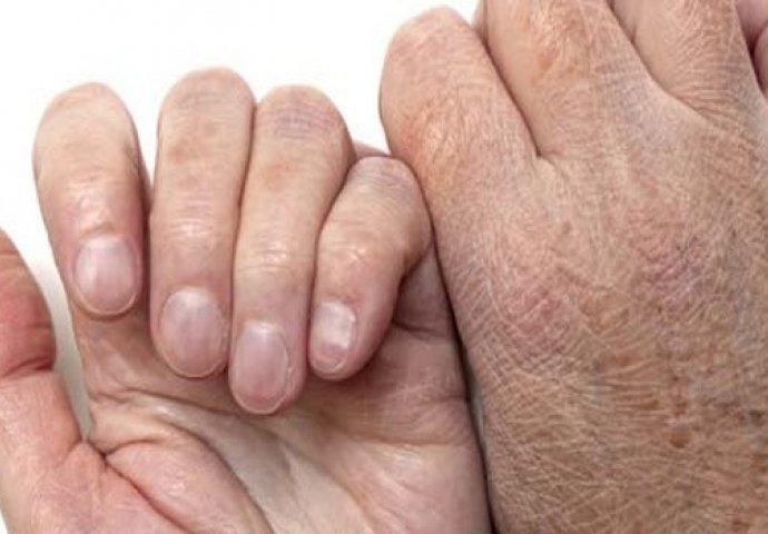 Obratite pažnju: Saznajte da li vaše šake pokazuju rane simptome raka