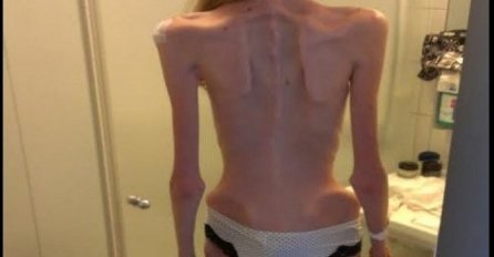 Imala je samo 30kg i jedva je disala: Odlučila je da svetu pokaže jezive slike anoreksije