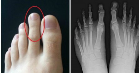 Pogledajte drugi prst na svom nožnom stopalu: Ako je ove veličine onda trebate nešto znati