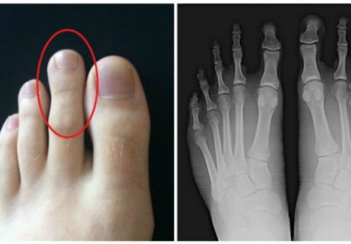 Pogledajte drugi prst na svom nožnom stopalu: Ako je ove veličine onda trebate nešto znati