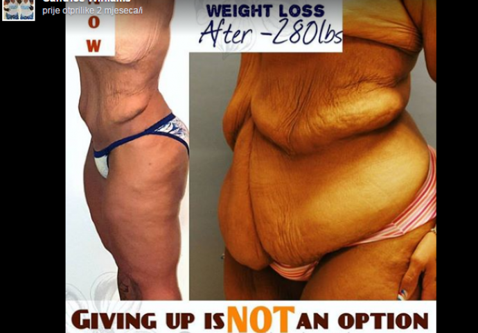 Nakon drastičnog mršavljenja ostalo joj je čak 6,5 kilograma suvišne kože, a onda je zamolila neznance za pomoć (FOTO)