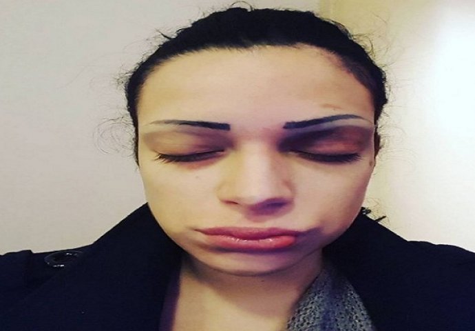 Srpska pjevačica koja je prebijena u Prištini, ponovo brutalno pretučena! (UZNEMIRUJUĆI FOTO) 