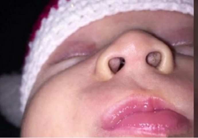 Pronašla je ovo u bebinom nosu: Kada je shvatila šta je zapravo, morala je potražiti pomoć (VIDEO)