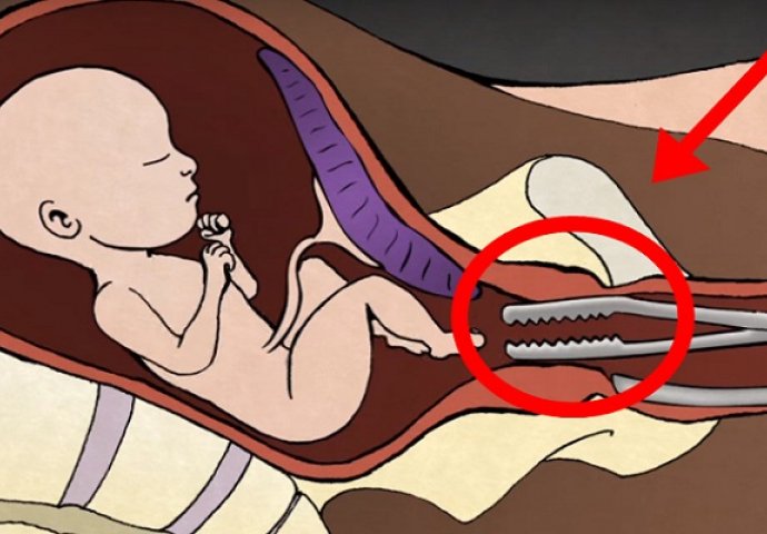 Uznemirujuće: Ginekolog otkriva šta se dešava sa bebom tokom abortusa (VIDEO)